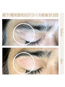 エスト(Est_.)/美容電気脱毛【眉毛】