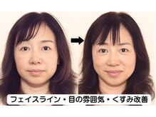 ニュートラル 池袋店(NEUTRAL)/施術結果【小顔、毛穴】