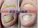肥厚爪の施術