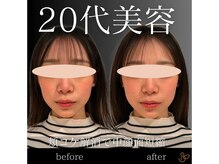 チョコバリ 郡山店(chocobari)/小顔×リフトアップ(美容鍼)20代