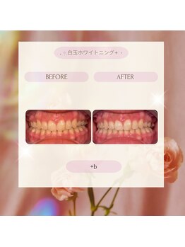 プラスビー 2号店(+b)/ホワイトニングビフォーアフター
