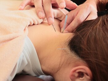 らくなん接骨院 鍼灸院の写真/痛みの少ない、お肌に優しい鍼で内側からキレイを叶えます◇美容鍼でお顔をしっかりリフトアップ♪