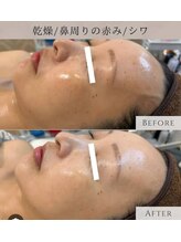 ピュアリ(Purely) /肌質、毛穴改善