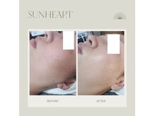 大人気！フォト美顔♪美白効果抜群！！