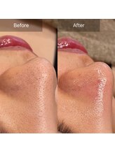 コアラル 恵比寿(COALALU)/毛穴洗浄/ハイドロスキン/くすみ