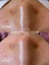 ユフラ(Juhla)/韓国3D毛穴＆ララピール