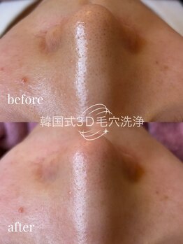 ユフラ(Juhla)/韓国3D毛穴&ララピール