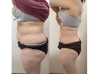 Kino Beauty Salon二子玉川店 ローマピンク/ホワイトラボ/脂肪冷却/シミ/メラニンケア/脂肪冷却