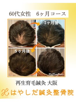 はやしだ鍼灸整骨院/育毛促進鍼灸で自信を取り戻す！