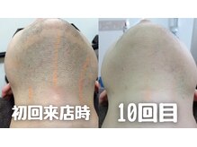 リムーブ(Re:move)の雰囲気（髭脱毛☆全男性の悩み青髭卒業！毎朝の自己処理不要で清潔肌へ！）