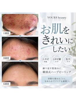 ユアーズ ビューティー(YOURS beauty)の写真/京都唯一の11種類の国産ハーブピーリングで、ニキビケアと輝く素肌へ♪★