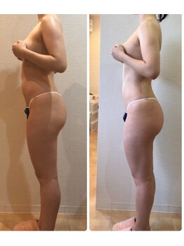 カロン(Kalon)/痩身