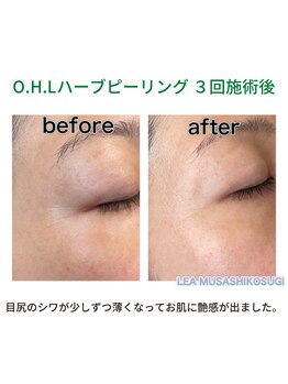 レア 武蔵小杉(LEA)/美肌ハーブピーリング：当店施術