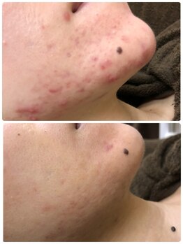 アンジェロ/【ニキビケア】肌育プログラム