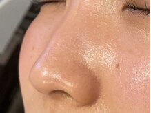 オアシスラグーン(OASIS LAGOON)/毛穴ケア（症例３：after）