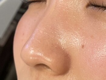 オアシスラグーン(OASIS LAGOON)/毛穴ケア(症例3:after)