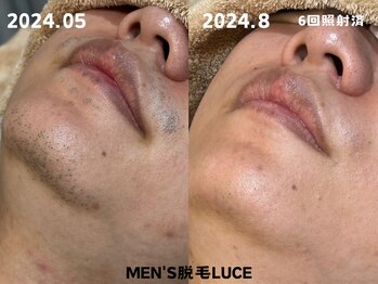 ルーチェ/【ヒゲ脱毛】美肌も手に入る!