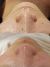 ミニ(MINI)/毛穴小顔ケア