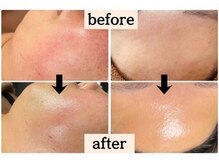 BRUSH/肌質改善でツヤのある美肌へ