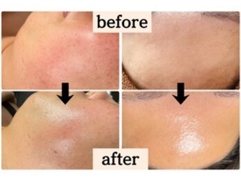 BRUSH/肌質改善でツヤのある美肌へ