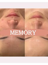 メモリー(MEMORY)/ニキビ、赤みが改善◎