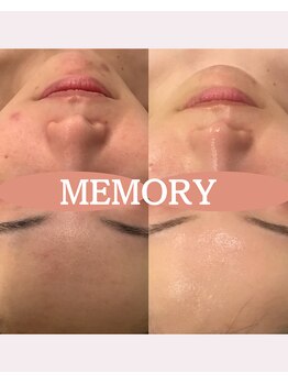 メモリー(MEMORY)/ニキビ、赤みが改善◎