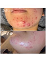 シャンブル(Chambre)/ニキビ肌にもプラウェーブ