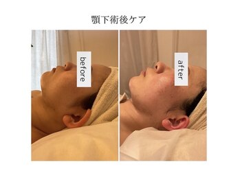 ファミーユ 豊橋店/【顎下術後ケア】吸引後ケア