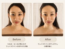 オーバイワン 自由が丘本店(Oby1)の雰囲気(頬の横幅がすっきりし、フェイスラインがシャープな小顔印象に)