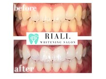 リアリ 宮崎(RIALI.)/プラチナホワイトニング