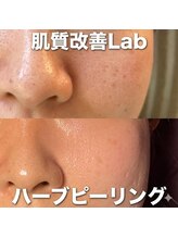 肌質改善Lab｜韓国美容/毛穴/ハーブピーリング/ニキビケア｜/ハーブピーリング｜ニキビケア