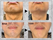 シュシュ(chou chou)の雰囲気（脱毛部門連続受賞業界NO.1VICTORIA導入★頑固な髭や白髪にも◎！）