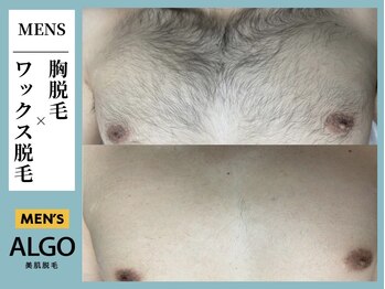 アルゴ 飯塚店(ALGO)/胸ワックス脱毛