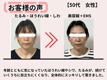 サロンスマイル/50代美容鍼ビフォーアフター