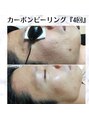 サロン レピア(LEPIA)&nbsp;メンズのケアも可能☆諦める前に一度お越しください。