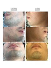 アイスタイル(i-style)/ひげ脱毛♪