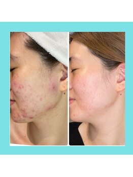 シエン ボーテ 馬車道 関内(Cyen BEAUTE)/施術10回目の効果