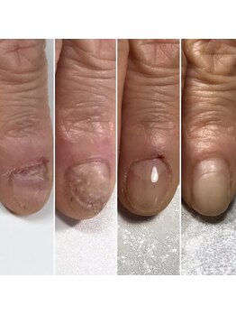 爪むしりでほとんど生えない爪が