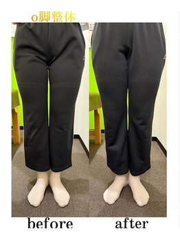 枚方わだち整骨院/O脚改善ビフォーアフター