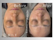 リリー(RILY)/【プラズマビフォーアフター】