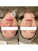 ルプレ(Lupure)/ハーブピーリング６回目