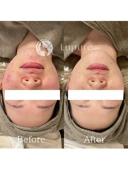 ルプレ(Lupure)/ハーブピーリング6回目