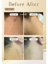 ルミライ(Lumirai)/たるみ改善|毛穴|フェイシャル