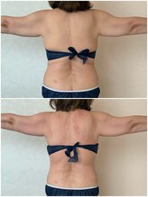 リノ(Lino)/上半身ケア