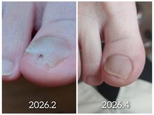 爪切り屋 足楽/爪甲下鶏眼