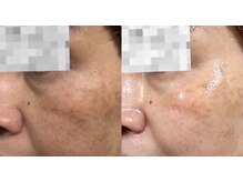 キレイになる路の雰囲気(シミ、肝ぱん、くすみ艶全てが手に入りノーファンデを目指します)