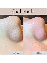 シエルエトワレ/毛穴エクストラクション