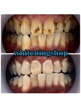 ホワイトニングショップ 鈴鹿店/Before&After美白ホワイトニング