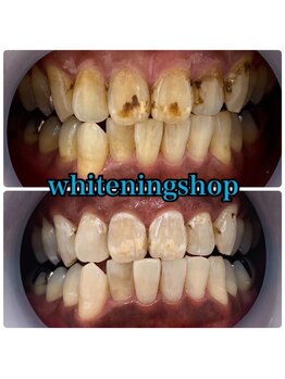 ホワイトニングショップ 鈴鹿店/Before&After美白ホワイトニング