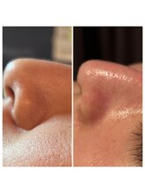 エミナル(Eminal)/◇毛穴エクストラクションtete式